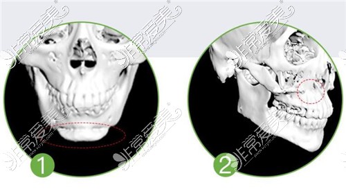 3D打印骨骼技术应用图示