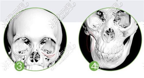 3D打印骨骼技术应用症状图示