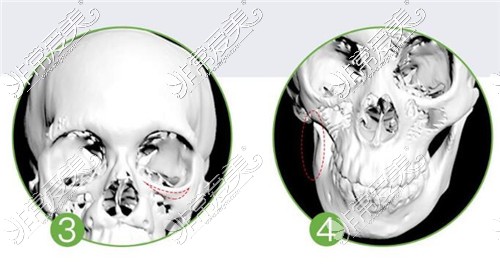 3D打印骨骼技術(shù)應(yīng)用癥狀圖示