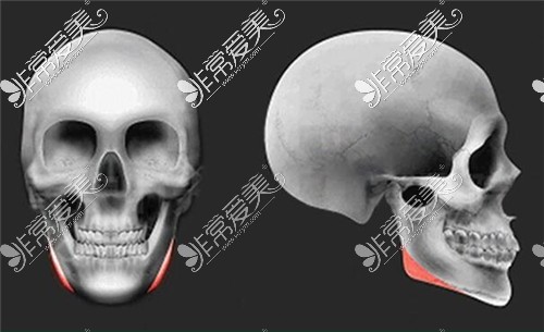 3d打印人造骨骼修复适应症图示