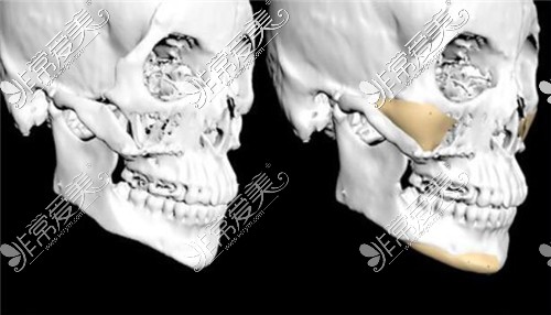 3d打印颧骨下颌角修复图
