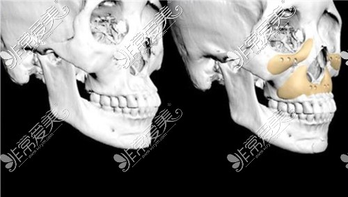 先天性骨缺损3d打印人造骨骼修复图