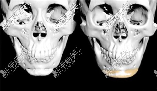 3d打印人造骨骼修复下颌角图示