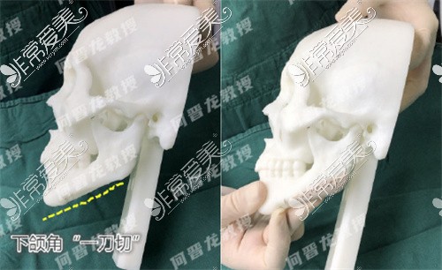 何晋龙医生3D打印修复下颌角展示图