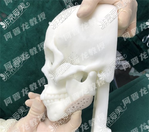 何晋龙医生3D打印修复下颌角图示