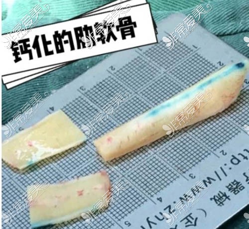 鈣化的肋骨材料照片