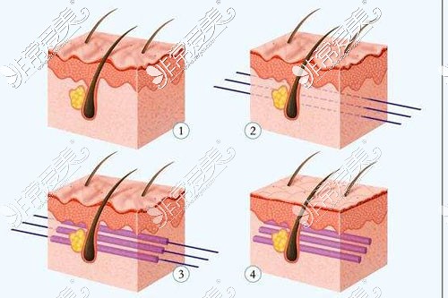 埋线提升皮肤层示意图