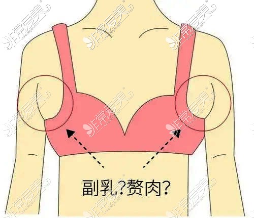 副乳和贅肉要分清楚