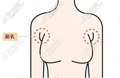 副乳的具体位置是在腋下