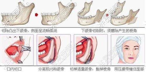 下颌角手术过程