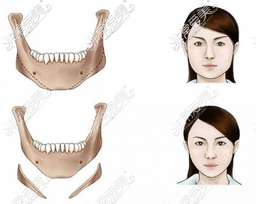 下頜角手術(shù)前后