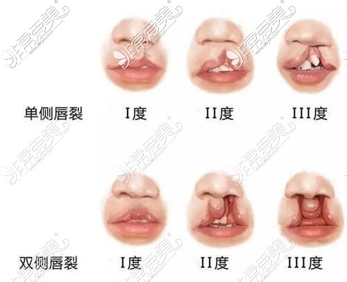 不同成都的唇裂情況