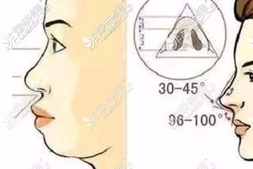 鼻基底凹陷对比示意图