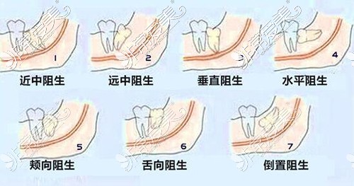 阻生齿类型图片