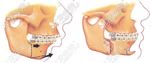 做完正颌手术后嘴更凸了?或者凸嘴变凹嘴?看正颌干货点我!