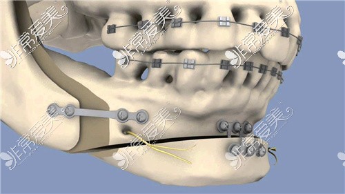 凸嘴手術(shù)后下巴單獨(dú)要往前