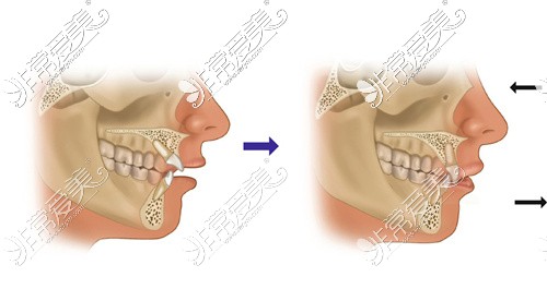 龅牙内收正畸对比