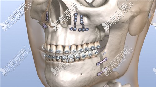 正颌手术钛钉固定
