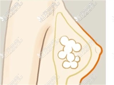 胸部奥美定位置图示