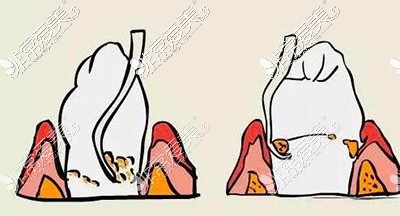 龈下刮治手术改善治疗