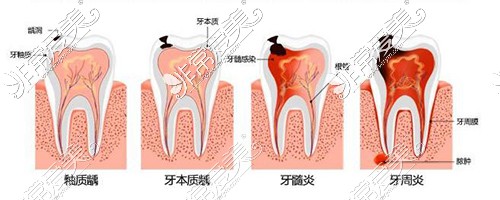 牙周疾病病变过程示意