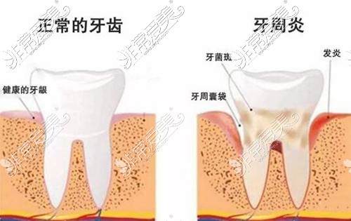 广州穗华口腔牙周疾病治疗
