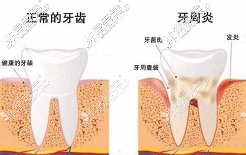 廣州穗華口腔牙周疾病治療