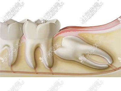 骨埋伏齿牙片
