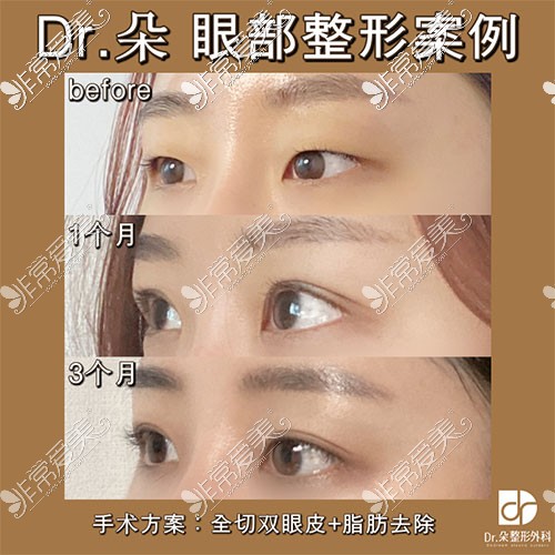 韓國dr朵眼整形對比照片