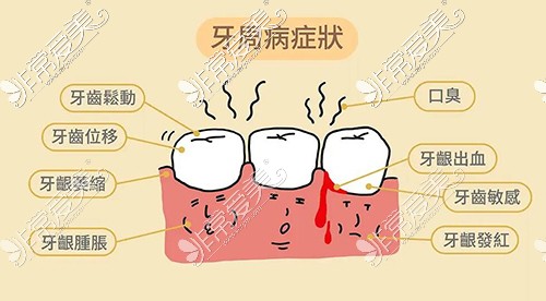 牙周疾病的症状有哪些