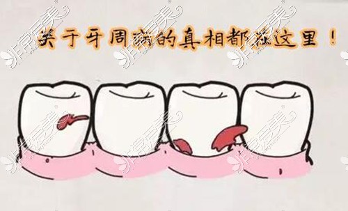 牙周病治疗卡通展示图