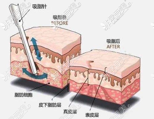 腰腹环吸后多久能变细？分享我做腰腹环吸恢复的全过程