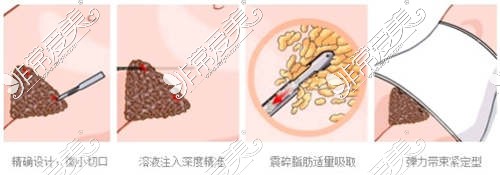 腰腹吸脂手術(shù)開口