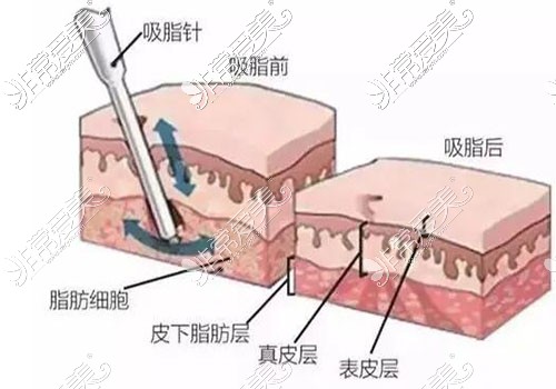 吸脂原理图