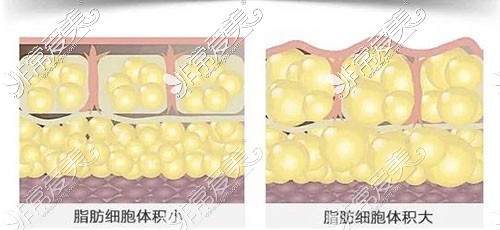 吸脂原理圖