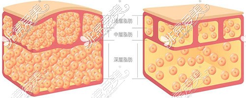 吸脂原理图