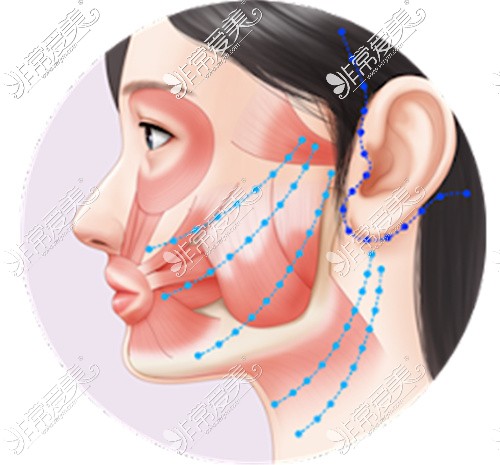面部颈部提升方向和切口