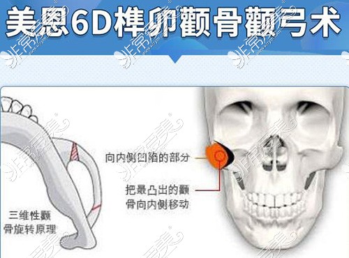 广州美恩整形美容6D颧骨整形手术