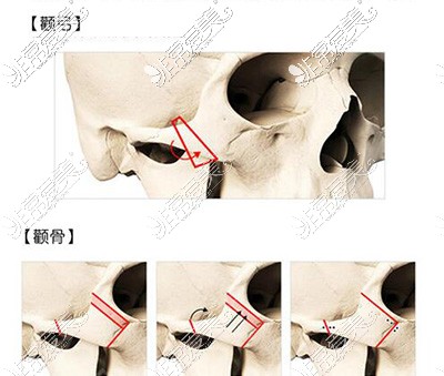 颧骨颧弓整形手术卡通图展示