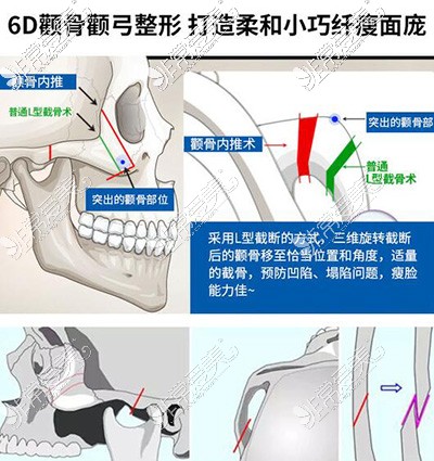 6D颧骨颧弓整形技术优势