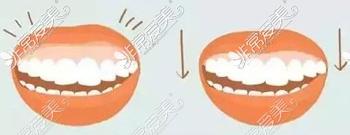 牙齿矫正时牙龈突出改善