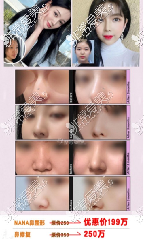 韩国NANA整形鼻部塑形优惠活动