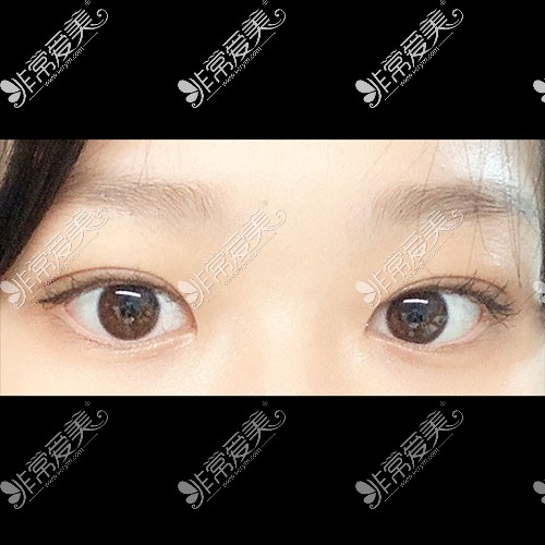 韩国icon双眼皮手术术后图