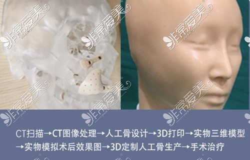 杭州整形医院颌面修复过程图