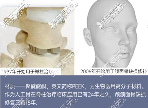 杭州整形医院下颌轮廓修复材料解析