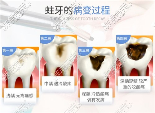 蛀牙的病变过程