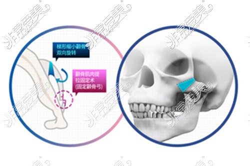 笑天双端点截骨技术