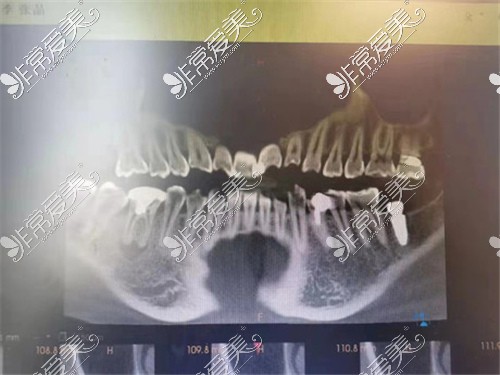 上海九慕美学齿科种植牙CT