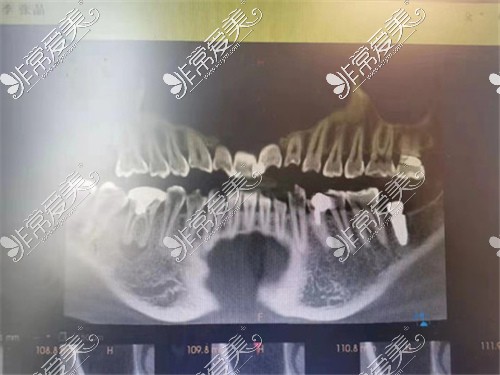 上海九慕美學(xué)齒科種植牙CT