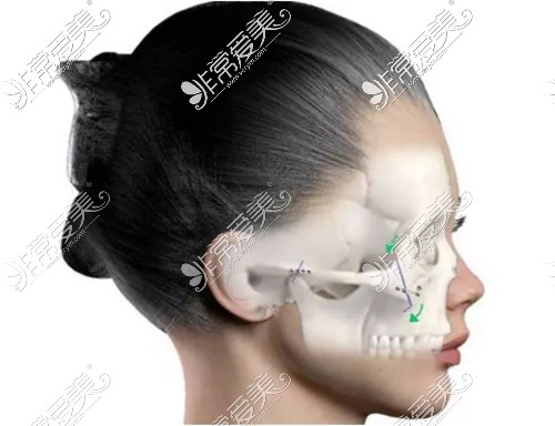 颧骨颧弓手术动画图